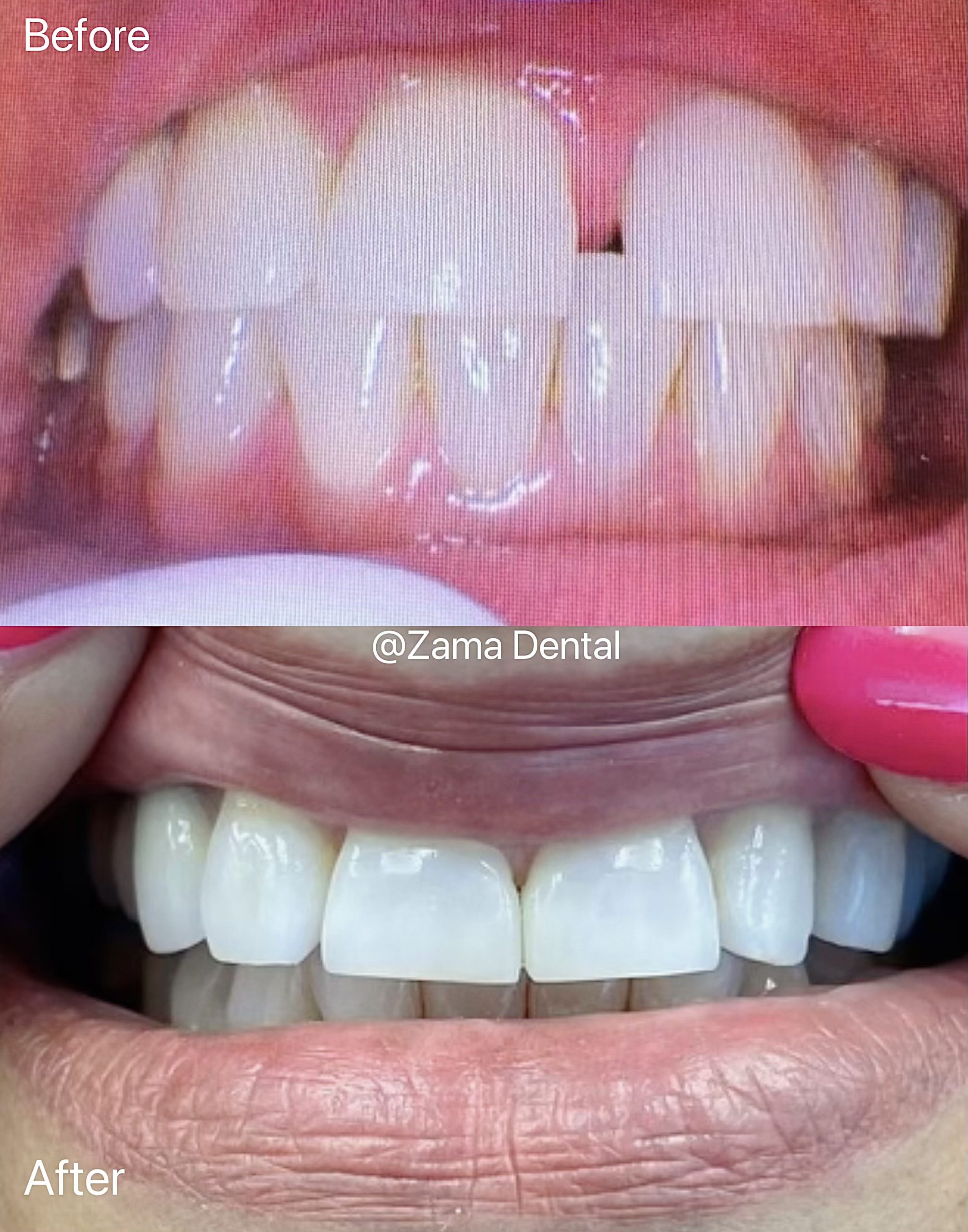 Composite Bonding Before and After