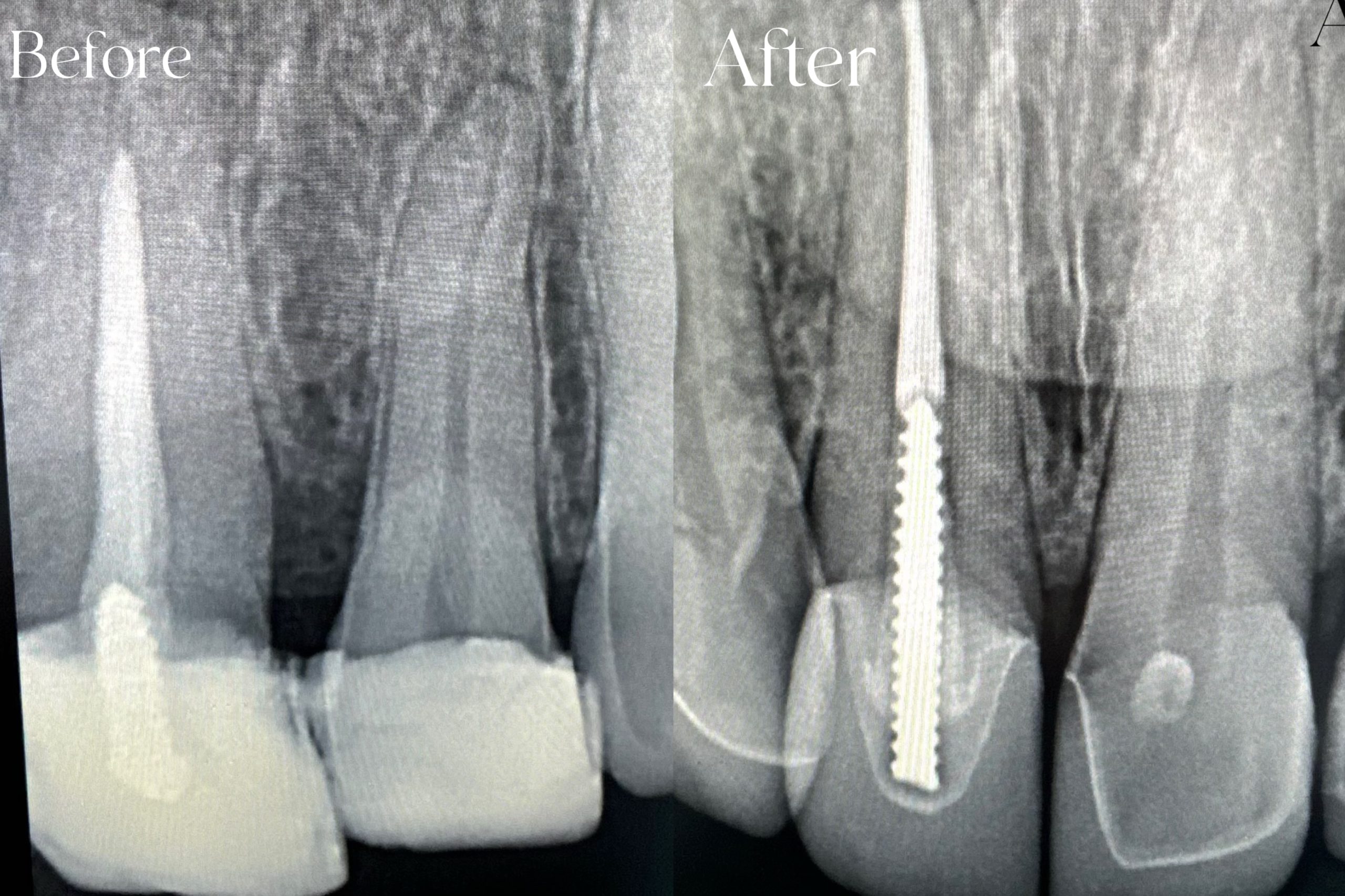 Root Canal Treatment Before and After